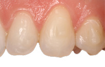 Ortodoncia Tres Torres Invisalign detalle diente