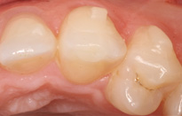 Ortodoncia Tres Torres Invisalign detalle diente