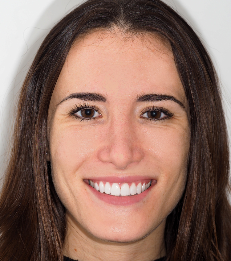 Miriam pudo corregir los espacios entre sus dientes mediante una combinación de ortodoncia con brackets de cerámica y ortodoncia Invisalign