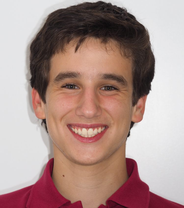 Carlitos pudo ensanchar el paladar con un tratamiento de ortodoncia con expansor de paladar y alinear los dientes con ortodoncia con brackets